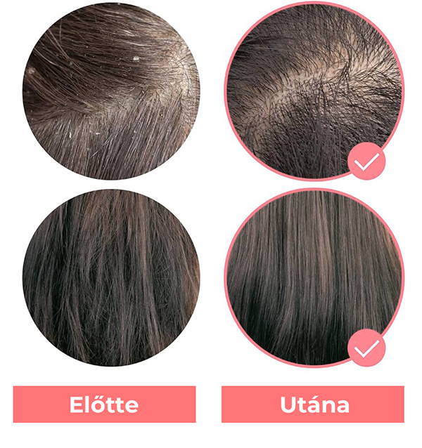 Fejbőr aloe vera előtt és után.