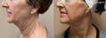 Side view of woman's lax neck before and after Morpheus8