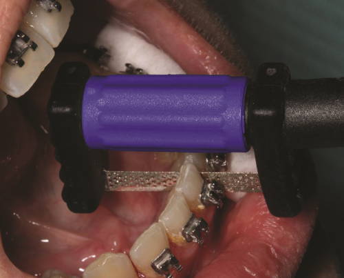 purple handle strip reducing enamel on teeth with brackets