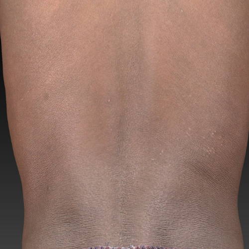 Dr Sknn Dermalux Tri-Wave MD Pigmentation Before