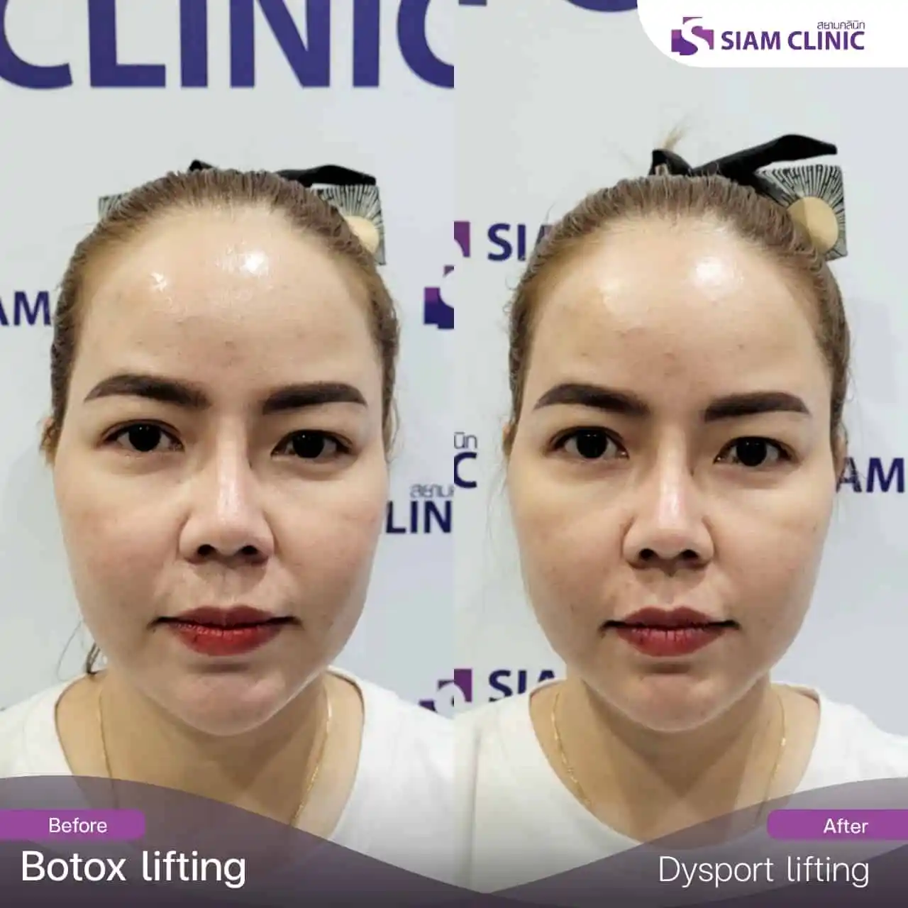 Botox Face Lifting