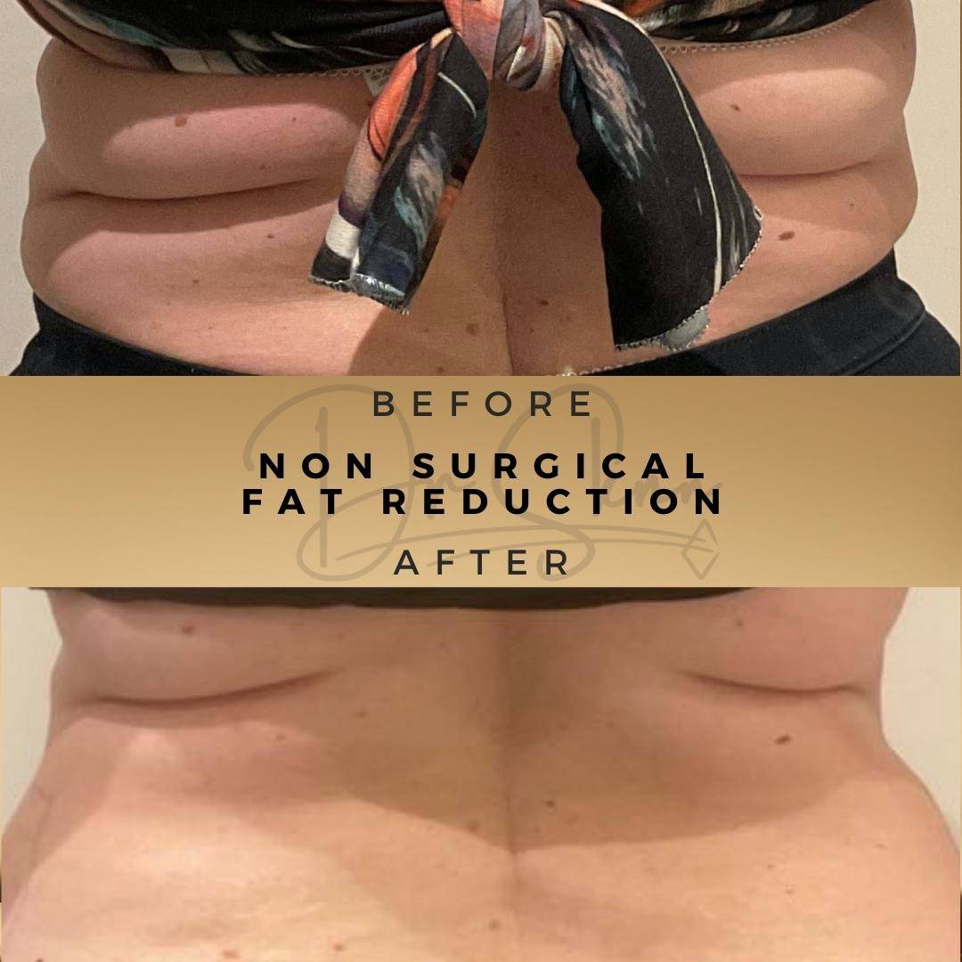 Non Surgical Fat Reduction Wilmslow Before & After Dr Sknn