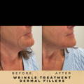 Perioral Line Fillers Wilmslow Before & After