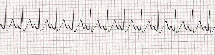 Sinus Tachycardia — heart rate greater than 100