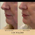 Lip Fillers Wilmslow with Anti-wrinkle injections