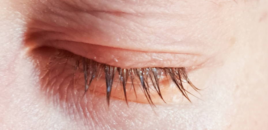 Eyelid eczema after Natural Elements Skincare
