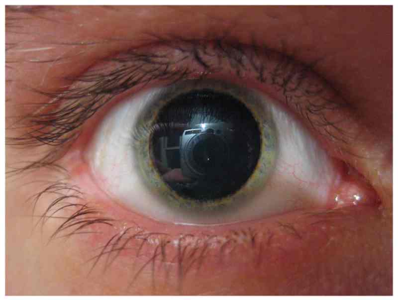 Can You Refuse Eye Dilation?