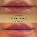 Lip Fillers Wilmslow with Anti-wrinkle injections