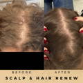 Hair Loss Treatment Dr Sknn Before & After Picture