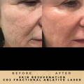 Skin Rejuvenation Co2 Fractional Laser Wilmslow Dr Sknn Before & After Picture