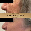 Cheek Fillers Wilmslow