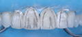 Pencil aligned incisors