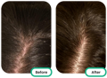before and after of the scalp after using the best tea tree oil singapore