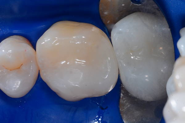 Posterior Restoration: after the Bioclear Method