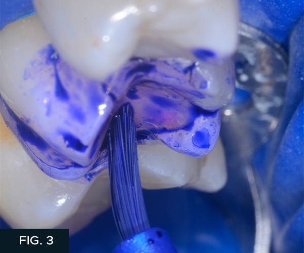 Disclosing solution is applied to a dry unprepared tooth* with a large applicator brush. *tooth displayed in the image is not from this case, but used to show the significance and importance of the Bioclear disclosing solution.