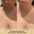 HydraChest Wilmslow Dr Sknn Before & After Picture