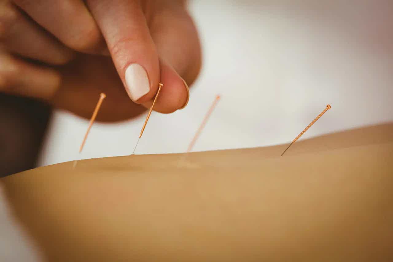 A hand performing acupuncture, inserting a needle into human skin with more needles in the background.