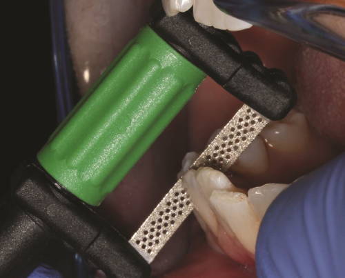 interproximal reduction with green handle strip
