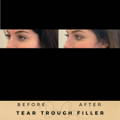 Tear Trough Fillers Wilmslow