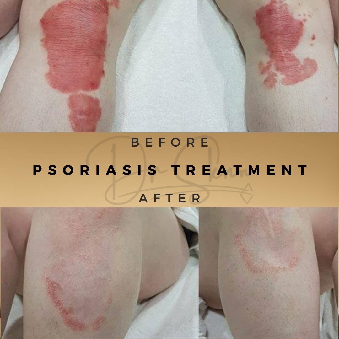 Psoriasis Treatment Wilmslow Before & After Dr Sknn