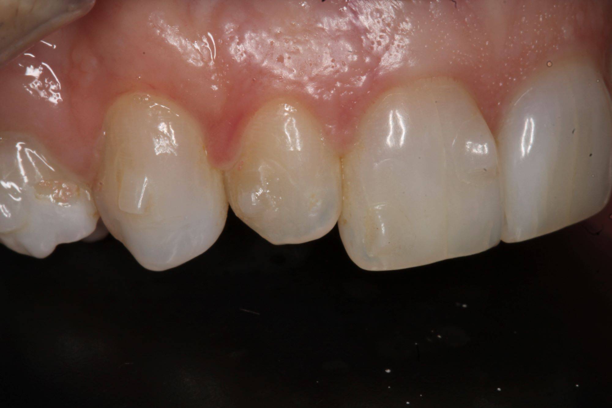 Smile close-up showing uneven lateral incisor pre procedure