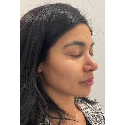 Dr Sknn Lip Fillers Before