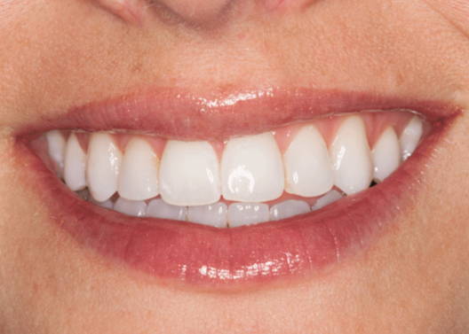 Smiling mouth before applying Enamelast Fluoride Varnish