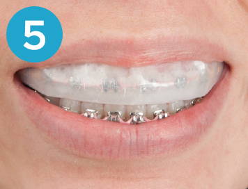 Smile with brackets covered by Go Ultrafit tray