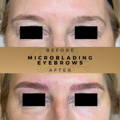 MICROBLADING EYEBROWS WILMSLOW Before & After Wilmslow, Cheshire Dr Sknn Aesthetic