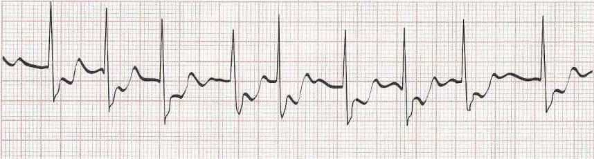 Atrial Fibrillation rate of 90 (irregular with no discernable P waves)