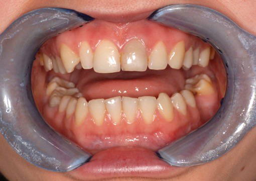 A patient with a non-vital endodontically treated anterior tooth: a discoloration is clearly seen