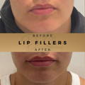 Lip Fillers Wilmslow with Anti-wrinkle injections