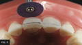 Polisher polishing anterior tooth