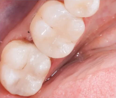 molars after Evanesce Silk restoration