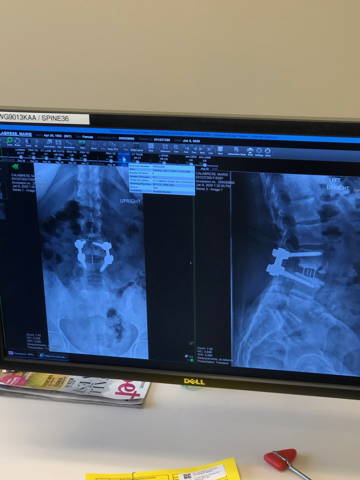 Green Bee Life Founder shares an X-ray of her spine after a Lateral Lumbar Interbody Fusion (XLIF) back surgery with hardware.