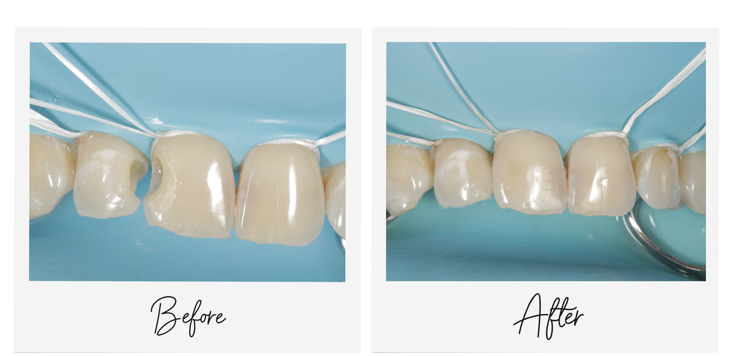 before and after restoration of anterior teeth isolated with dental dam