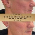 Pigmentation Treatment Co2 Fractional Laser Wilmslow Dr Sknn Before & After Picture