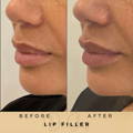 Lip Fillers Wilmslow with Anti-wrinkle injections