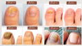 Animated Toenail Fungus