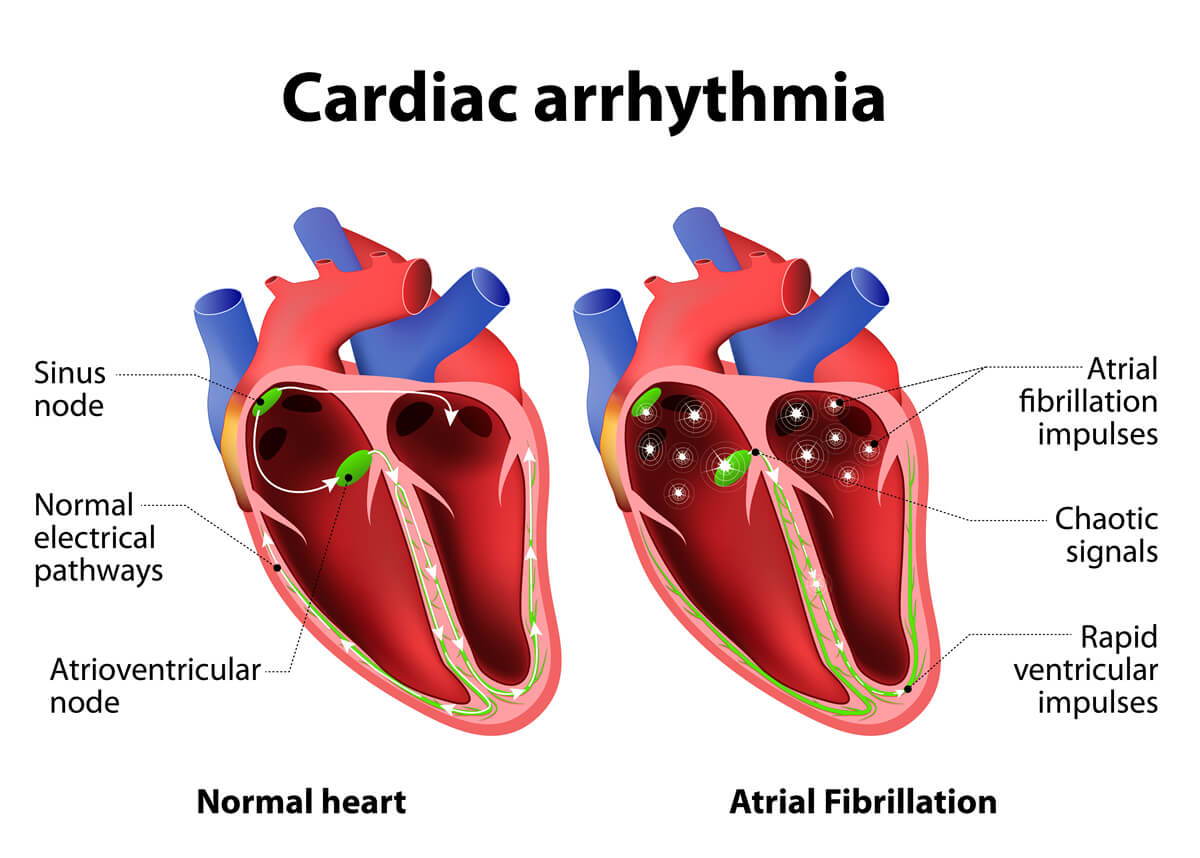 bradiaritmia, tachiaritmia, tachicardia sinusale, bradicardia sinusale, aritmia sinusale, battito prematuro, tachicardia parossistica, fibrillazione atriale, blocco cardiaco,