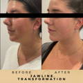 Jaw Fillers Wilmslow Before & After Dr Sknn