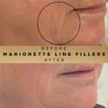 Marionette Line Filler Wilmslow Before & After Dr Sknn