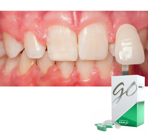 Opalescence teeth: after 2-weeks of wearing Opalescence Go whitening trays over the orthodontic brackets