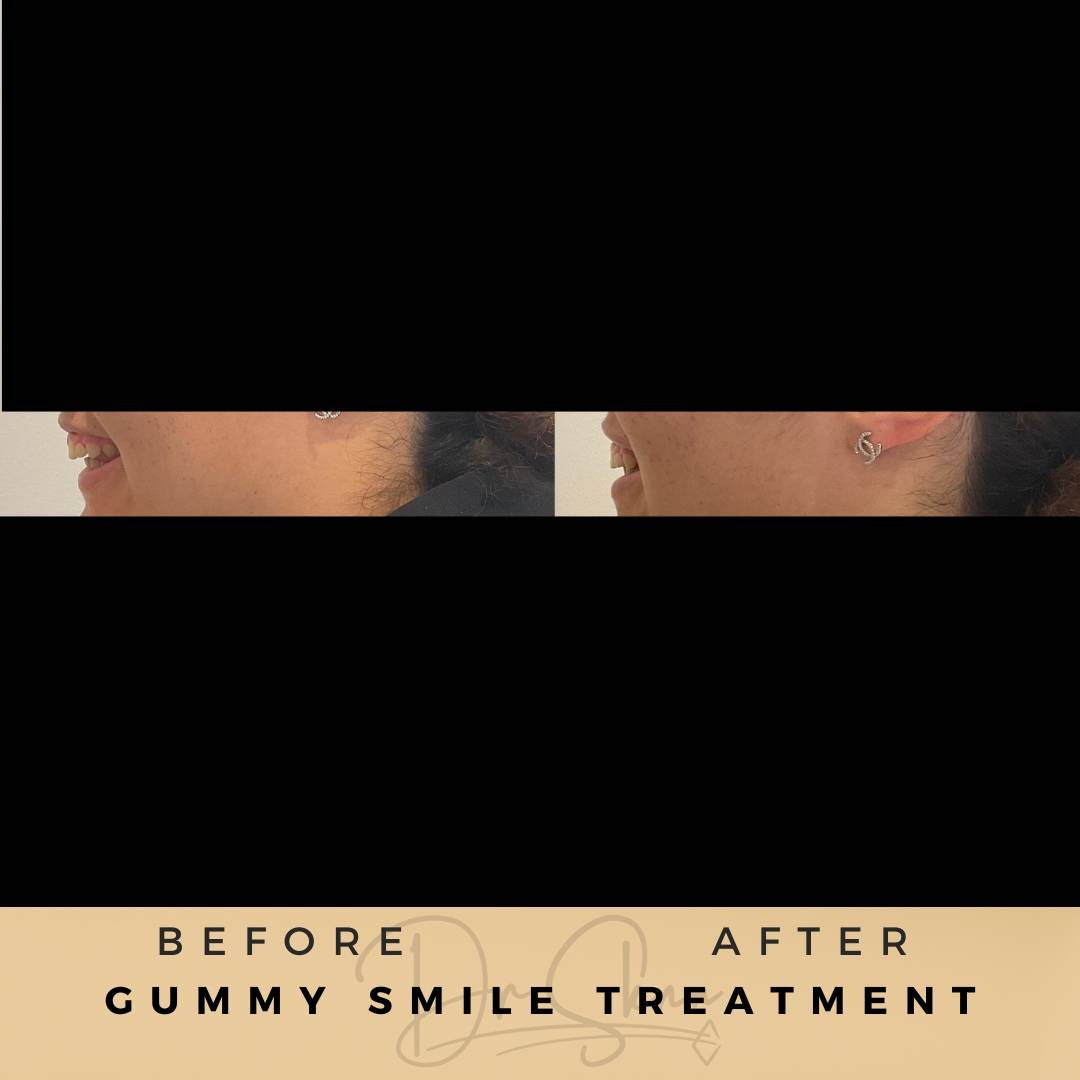Gummy Smile Treatment Wilmslow Before & After Dr Sknn