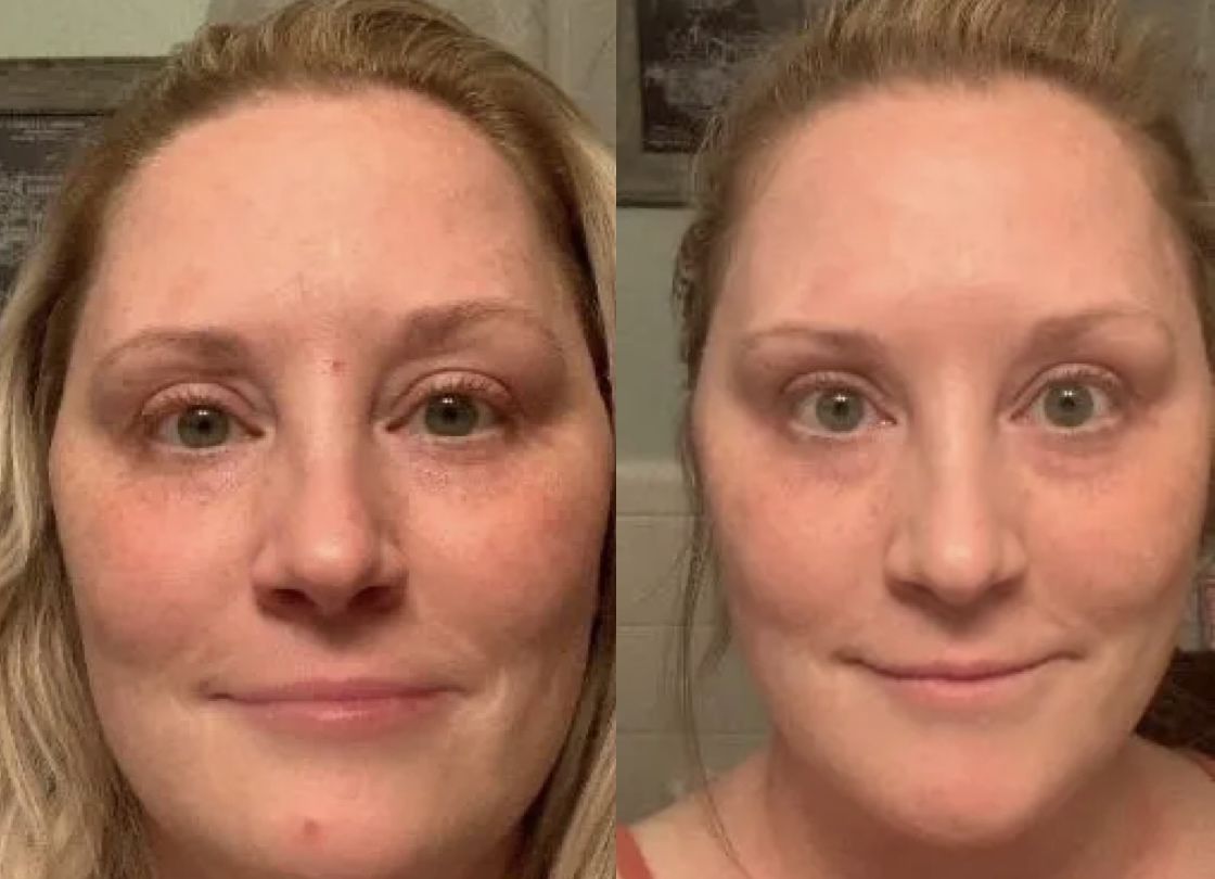 Brigitte P. before and after