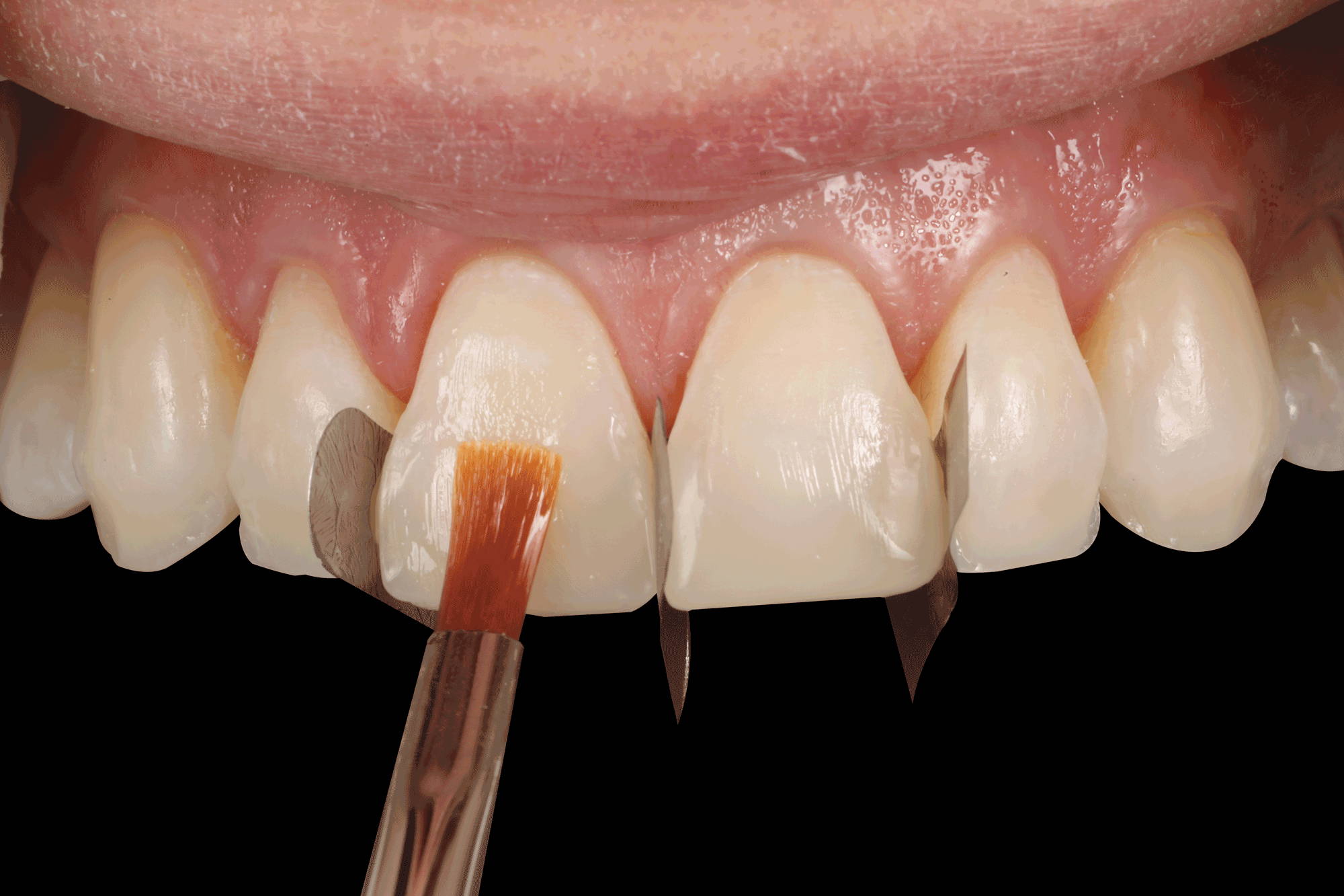 transparent material getting brushed into central incisor