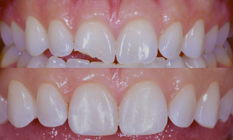 smile before and after restoration procedure