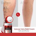 before and after Varicose Veins Relief Cream
