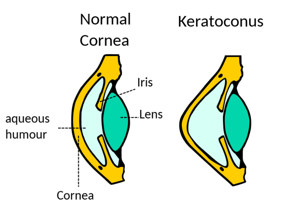 Steeper cornea with keratoconus