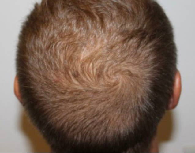 Dr Sknn Hair Restoration Before